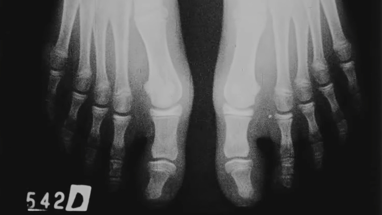 5to. dedo varo backdrop